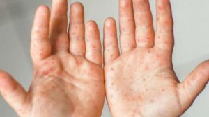 Lambayeque: Más de 30 casos del virus coxsackie alertan colegios de Chiclayo